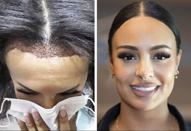 Vergleichsbild kurz nach dem Eingriff bei Elithair und das Endergebnis bei einer Frau nach Haartransplantation gegen Geheimratsecken bei Frauen 