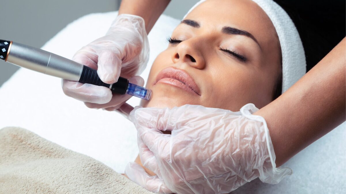 RF Microneedling: Der ultimative Weg zu jugendlicher Haut – Ein umfassender Guide