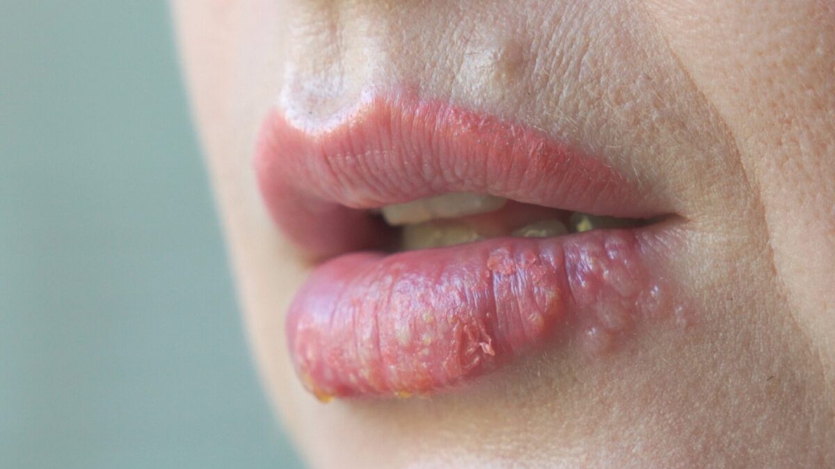 Entzündete Lippen: Ursachen, Arten und Behandlungsmöglichkeiten