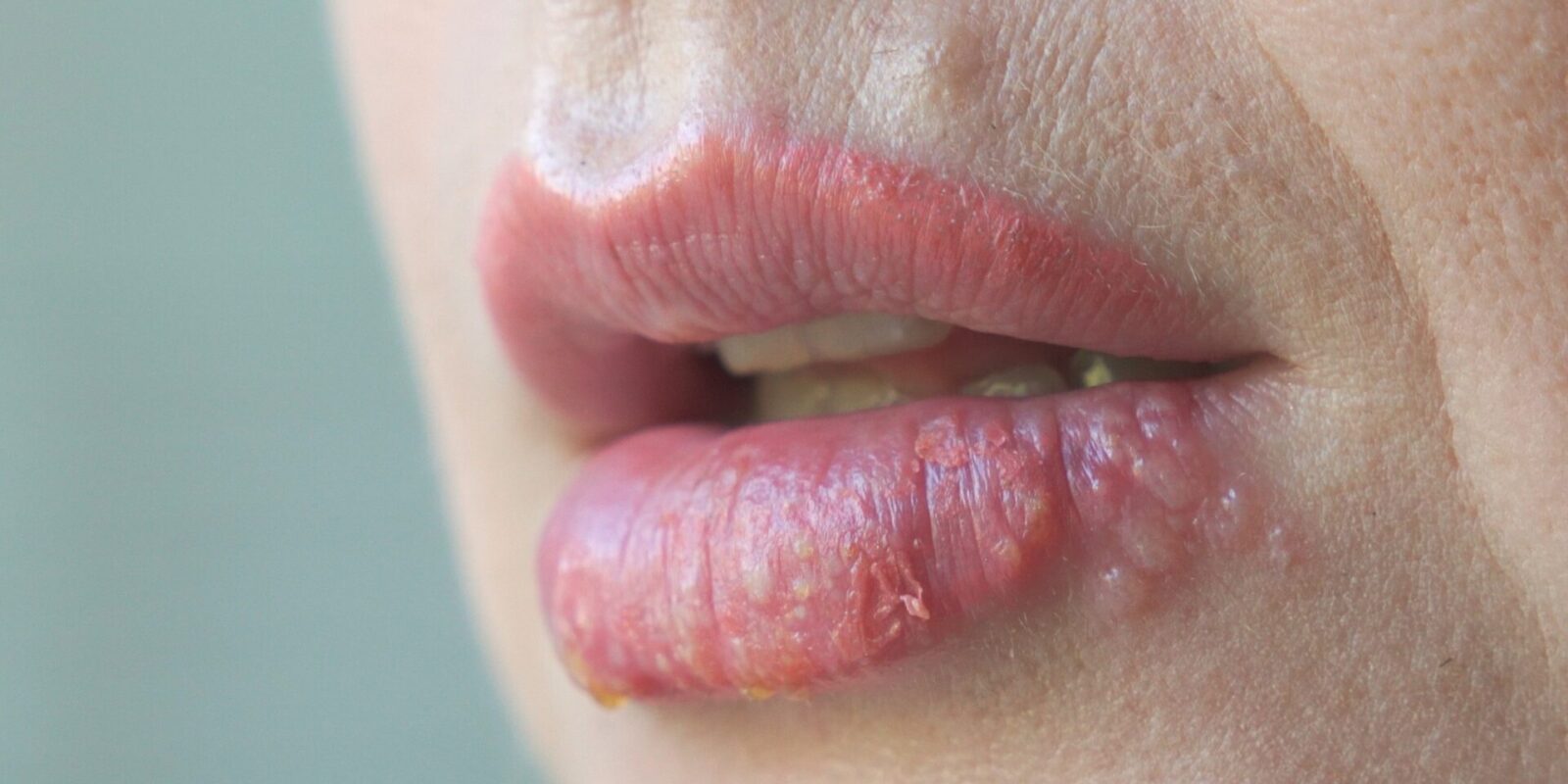 Entzündete Lippen: Ursachen, Arten und Behandlungsmöglichkeiten