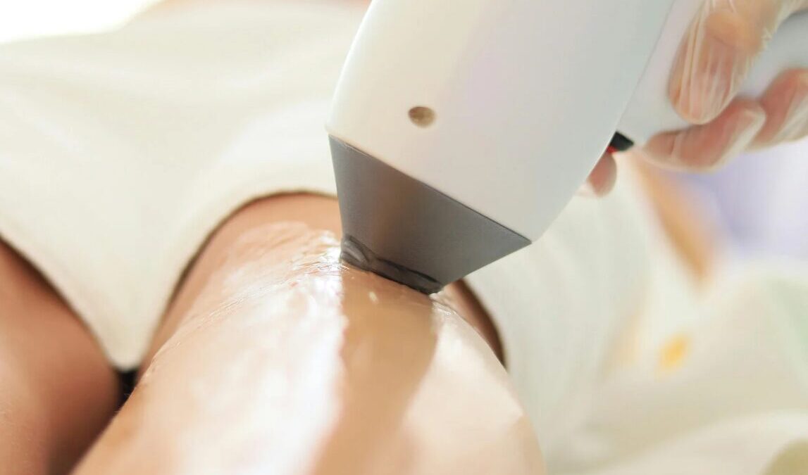 Laser-Haarentfernung in Berlin